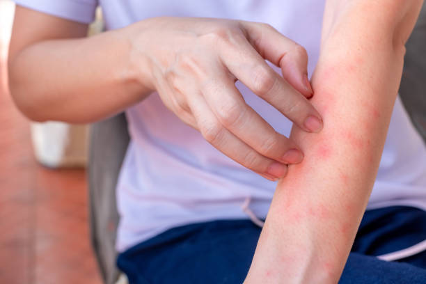 Close up of woman arm scratch the itch by hand at home